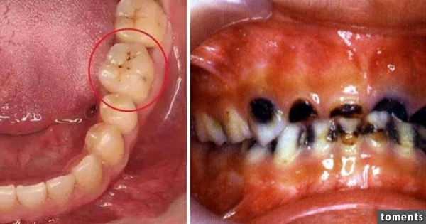 牙齿上出现这种小黑点请注意!如果忽视了后果可能会不