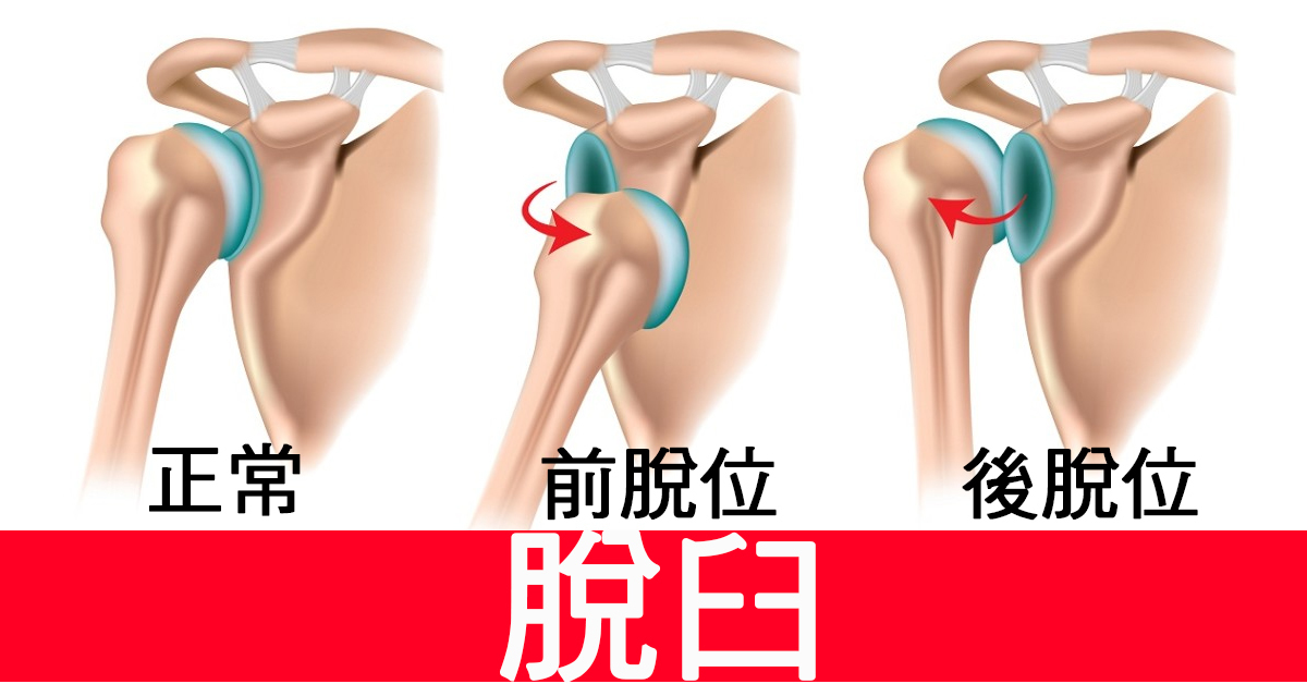 「肩脱臼」复发率高达八成!突发「四步骤」护你更「肩」康