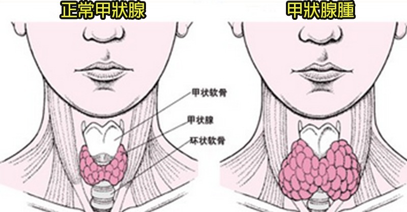 「甲状腺」疾病千万要避开「4类食物」!越吃脖子越肿吓死人.